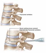 Vertebroplasty